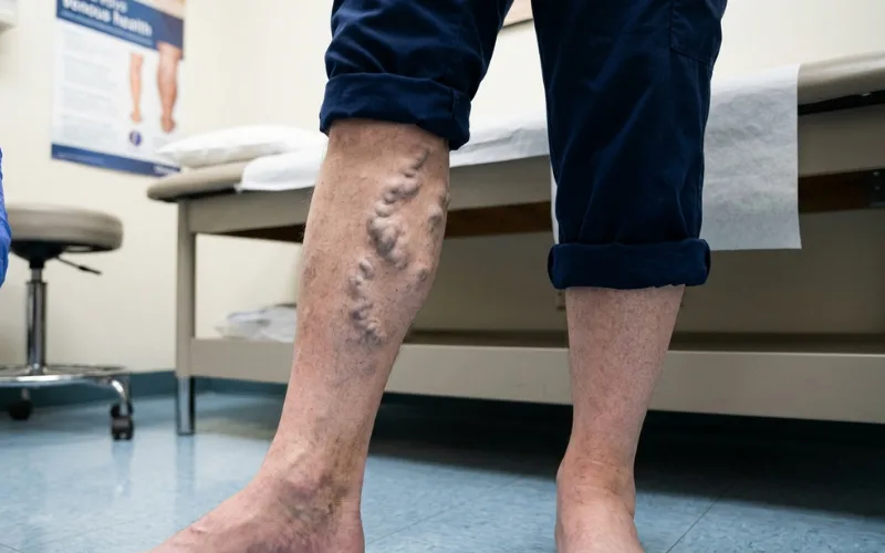 “Close-up of bulging blue varicose veins on lower legs, standing adult, clinical realistic healthcare image”
